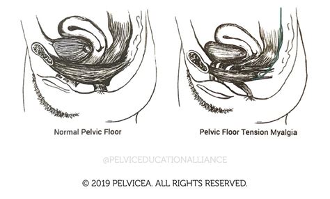 pelvic floor tension myalgia and pregnancy